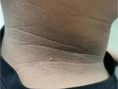脖子黑色素沉着是什么皮肤病?
