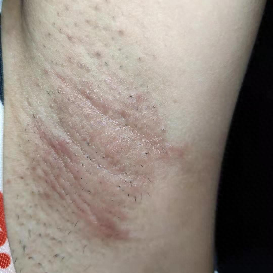 人为什么有狐臭怎么能去掉为什么在线 人为什么有狐臭怎么能去掉为什么在线