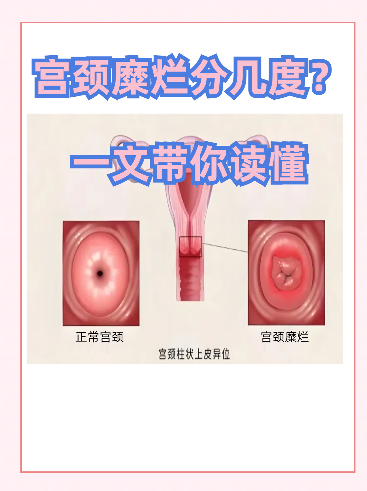 宫颈糜烂分几度?一文带你读懂