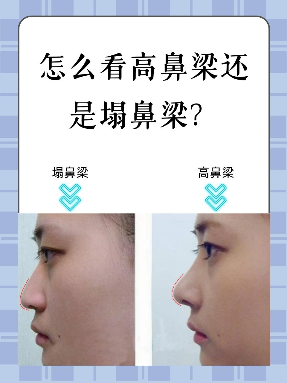 怎么看高鼻梁还是塌鼻梁?