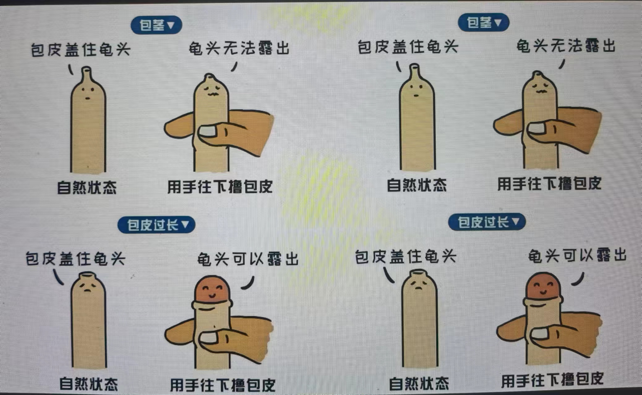 儿童包皮过长,需要割包皮吗