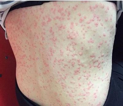 海鲜发物,添加剂就像"免疫炸弹",极易引爆过敏体质人群的