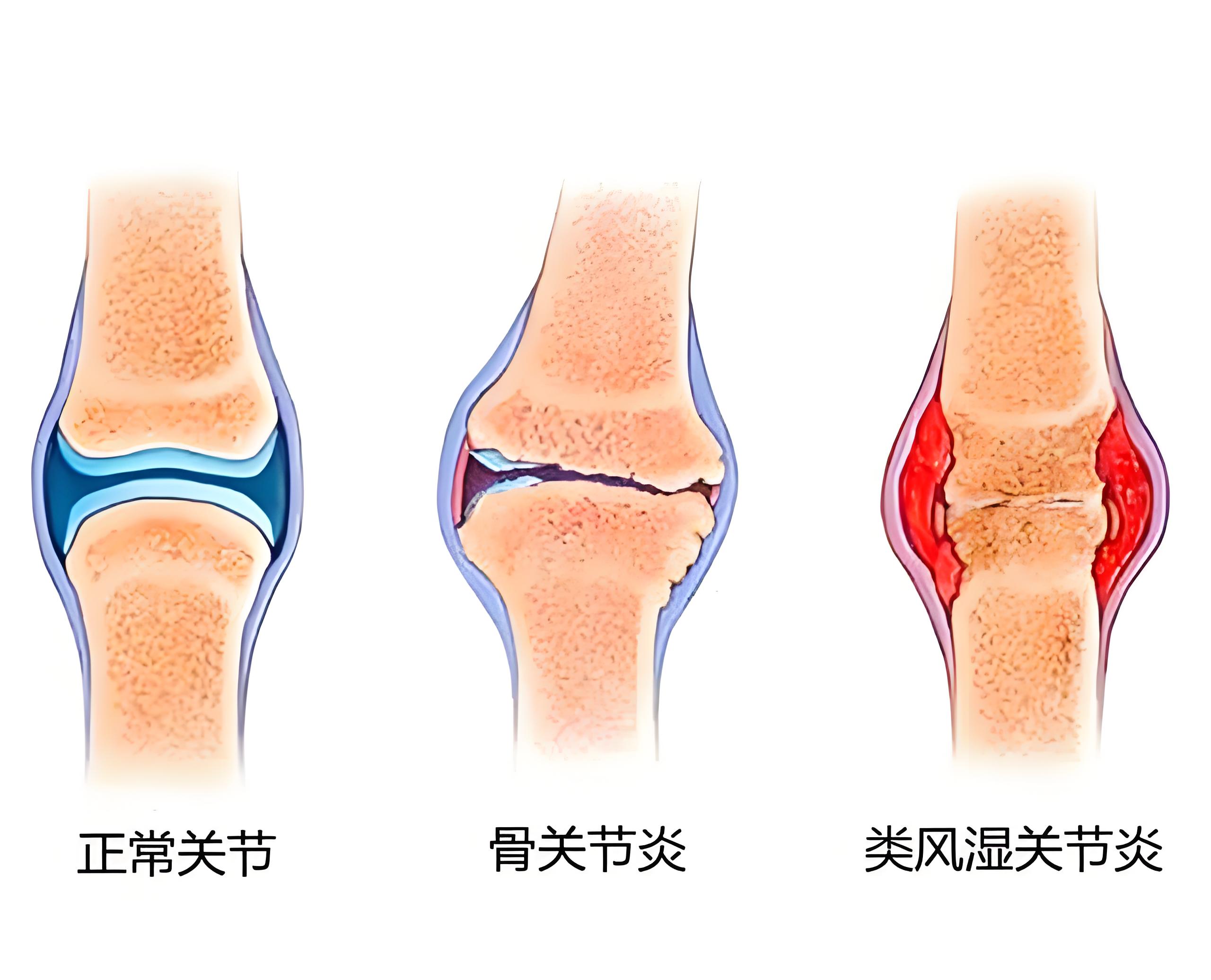 风湿性关节炎图图片