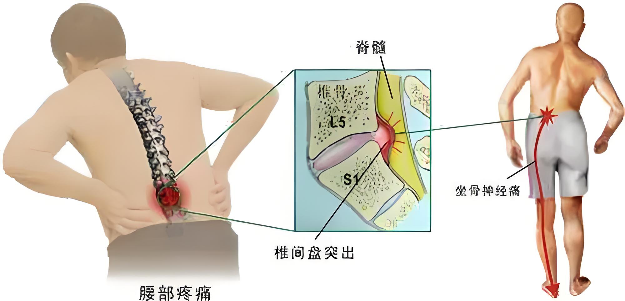 这几个症状,可能是腰椎间盘突出