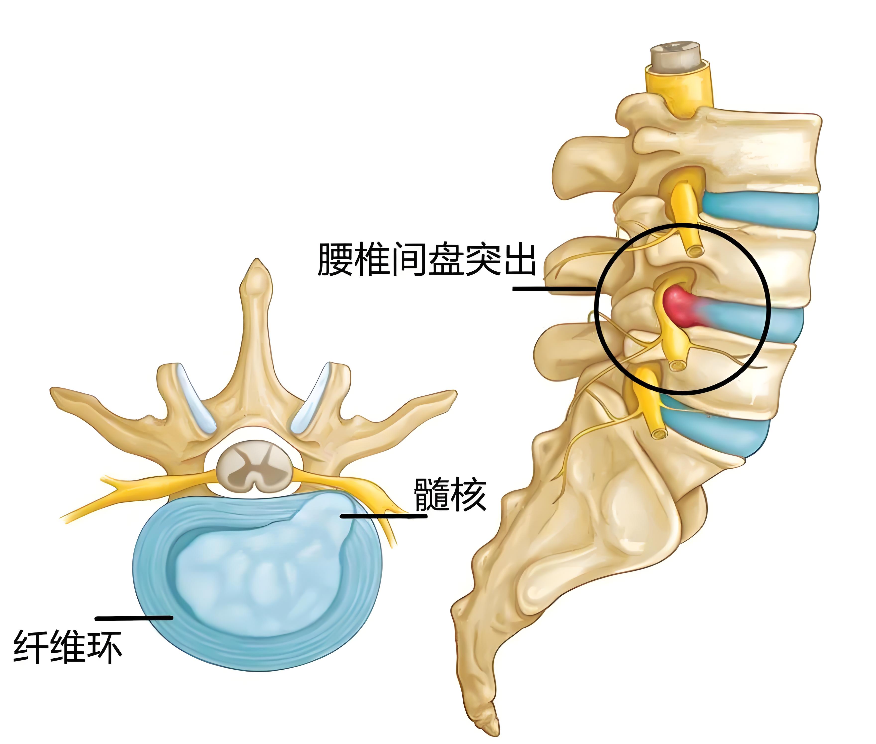 48 岁女子腰间盘突出,服用甲钴胺片营养神经,医生:注意 2 件事