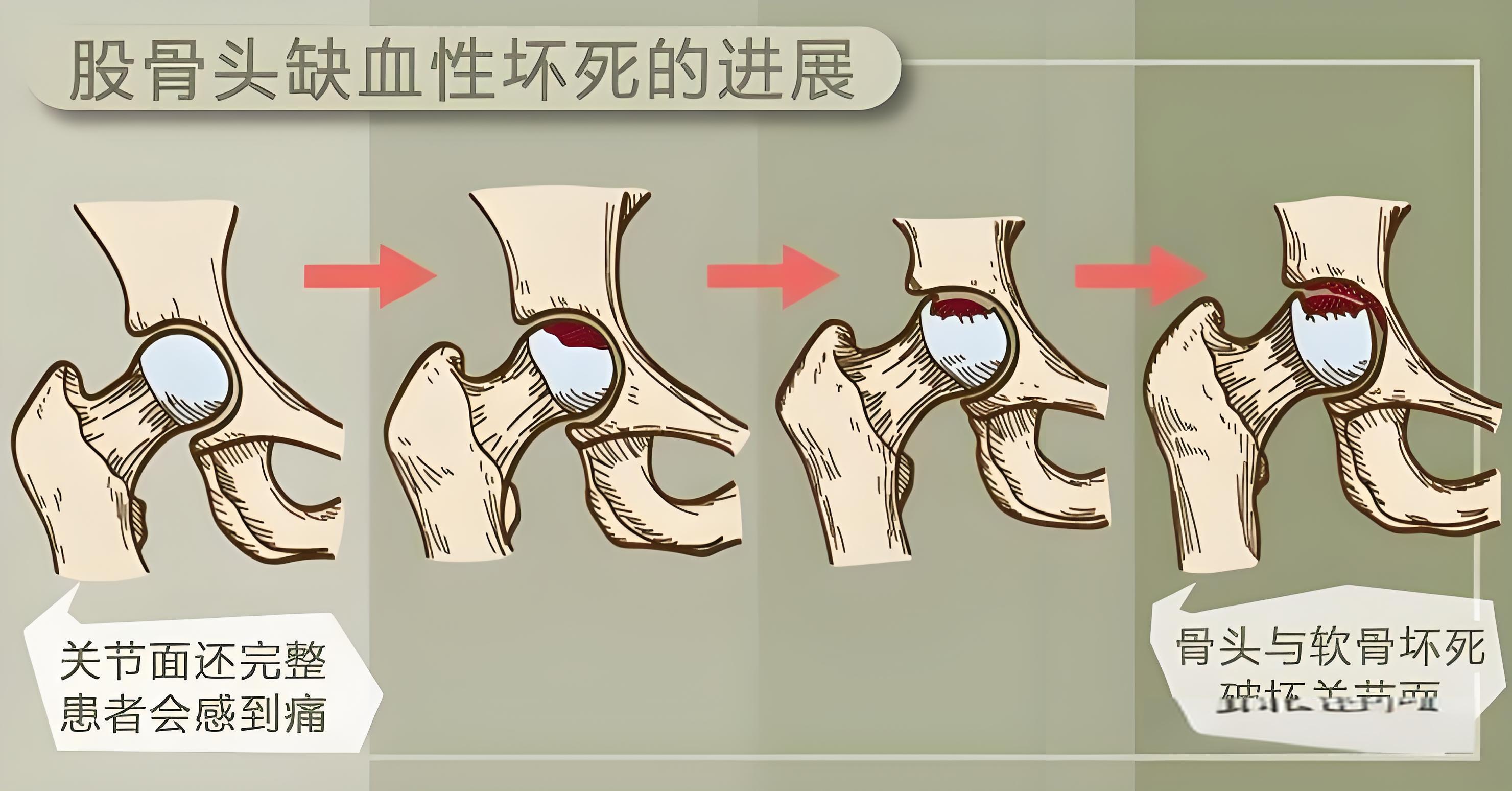 股骨头的图片 缺血性图片