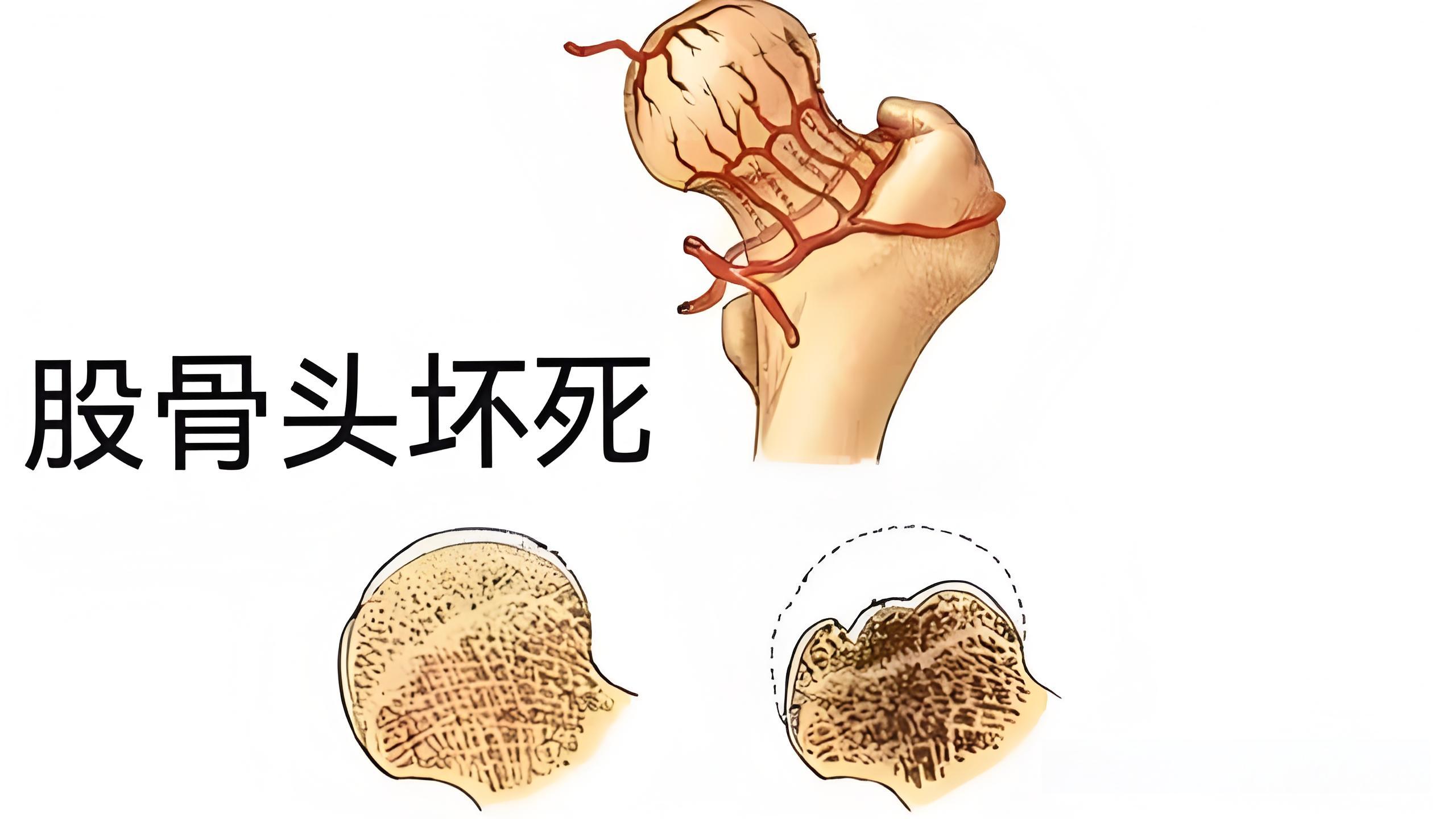 吃药锻炼效果差,股骨头坏死老不好?