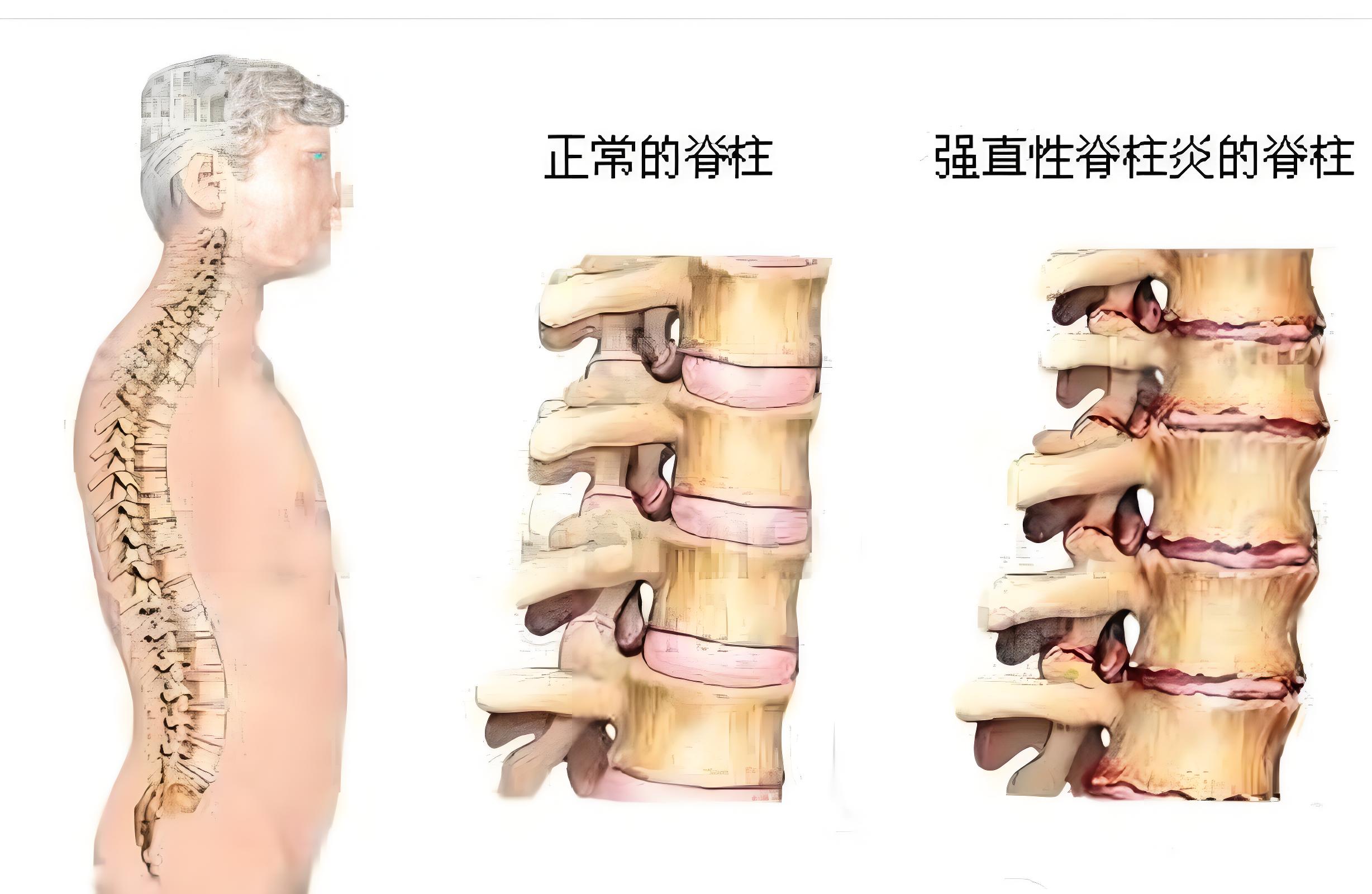 强直性脊柱炎患者一般多久可以停药