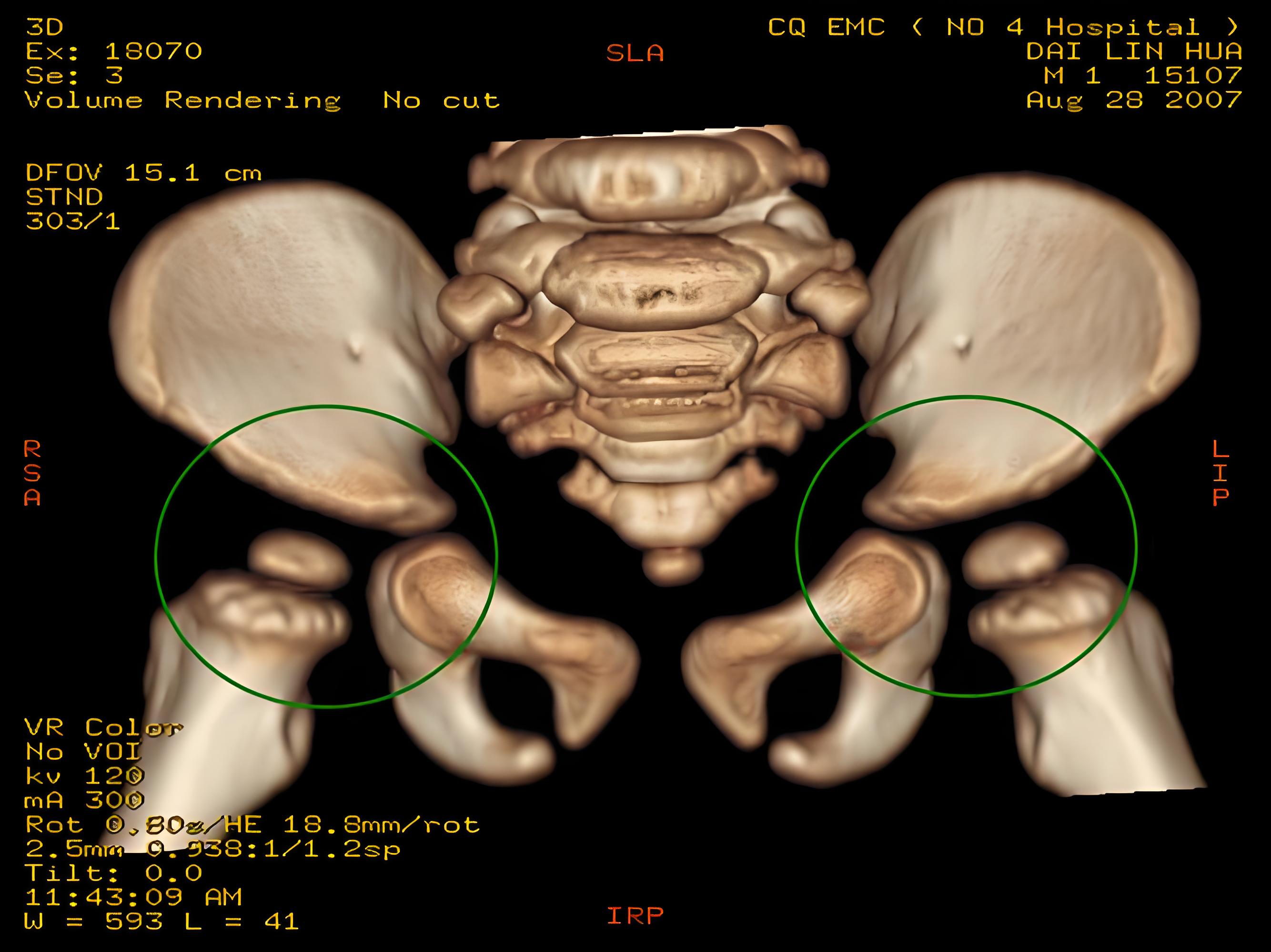 发育性髋关节发育不良是什么疾病?