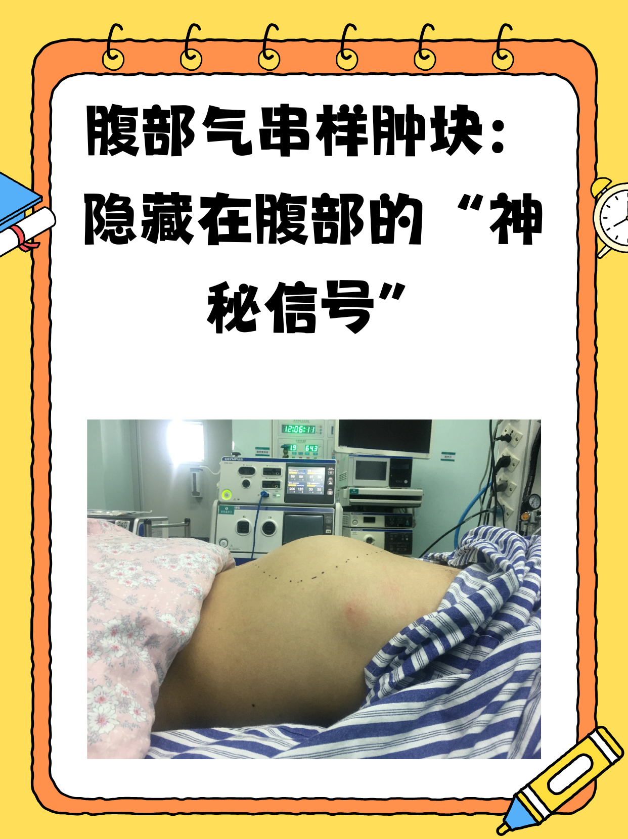 腹部气串样肿块:不可忽视的身体警报