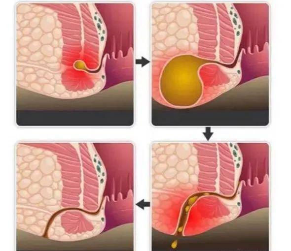 肛瘘,作为常见的肛门疾病,给患者的生活带来了不少困扰
