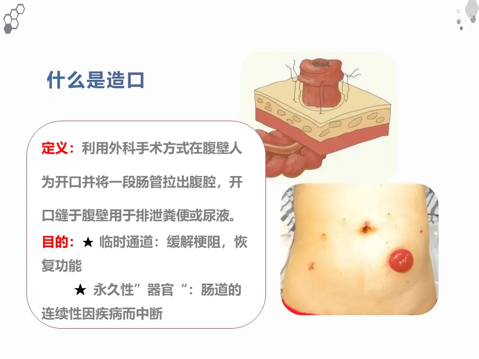 什么是直肠癌超低位保肛手术?