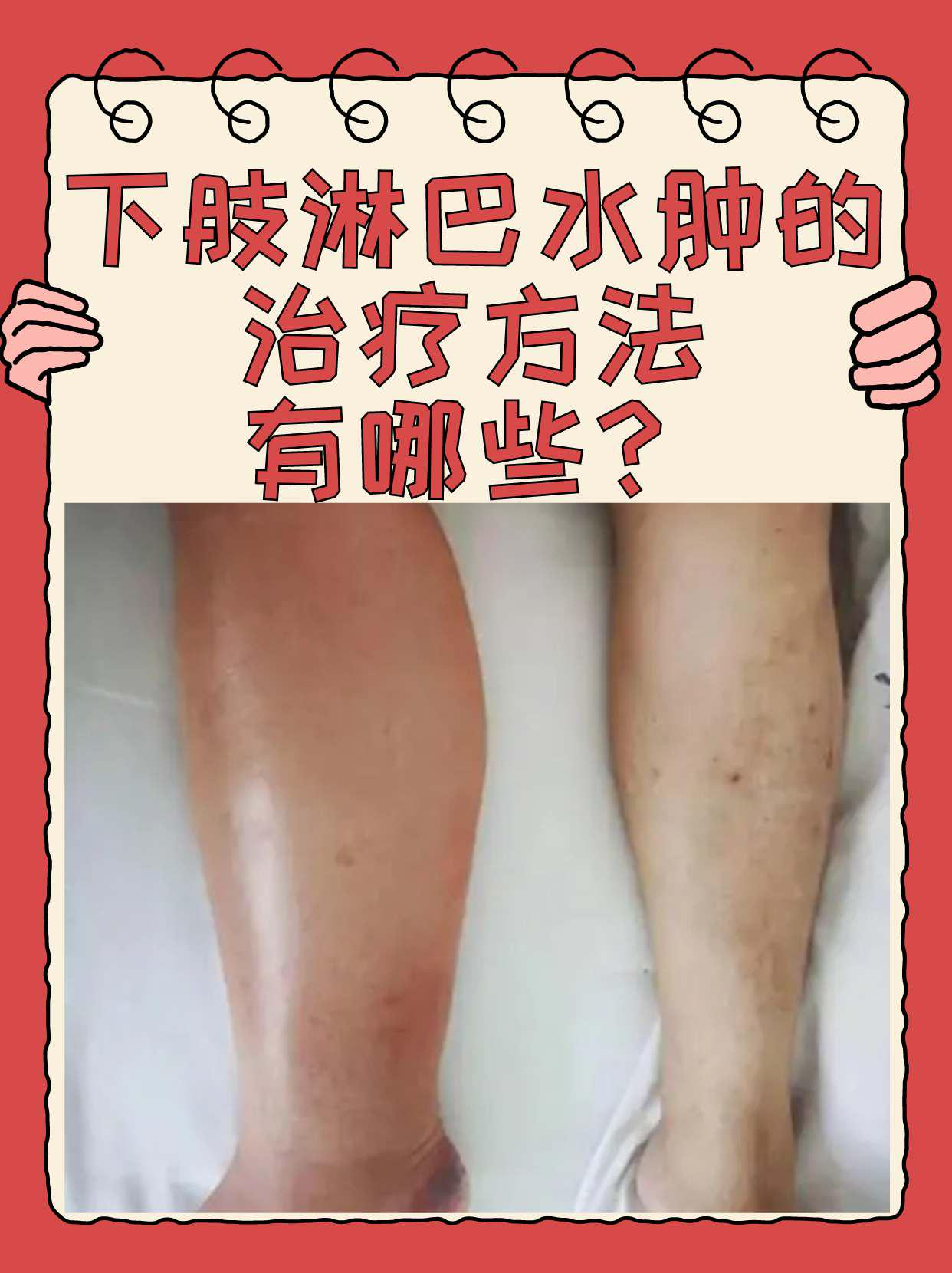 下肢淋巴水肿的治疗方法有哪些?