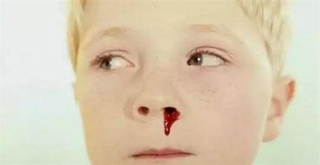 儿科医生说之浅谈儿童鼻出血的原因,家庭护理治疗以及预防