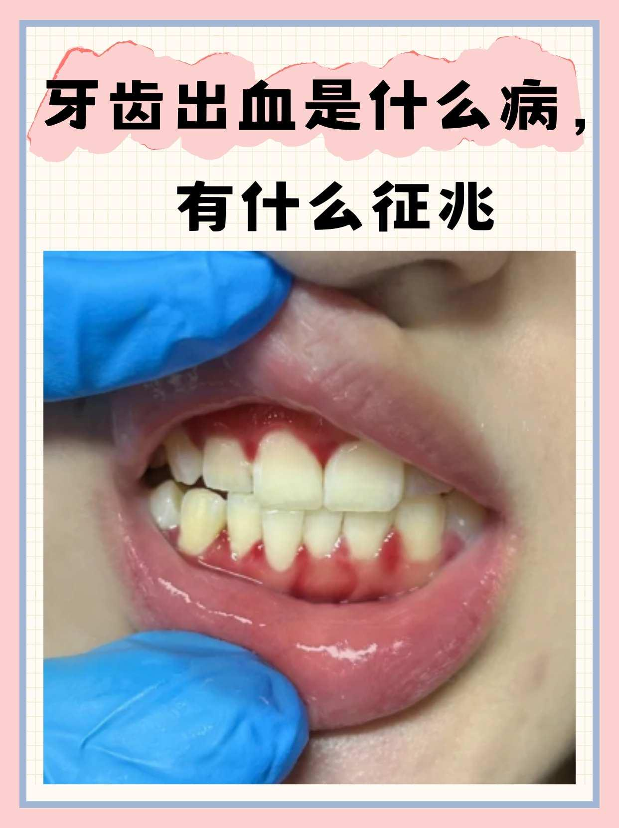 心脏支架吃药后为什么牙齿出血百科在线 心脏支架吃药后为什么牙齿出血百科在线