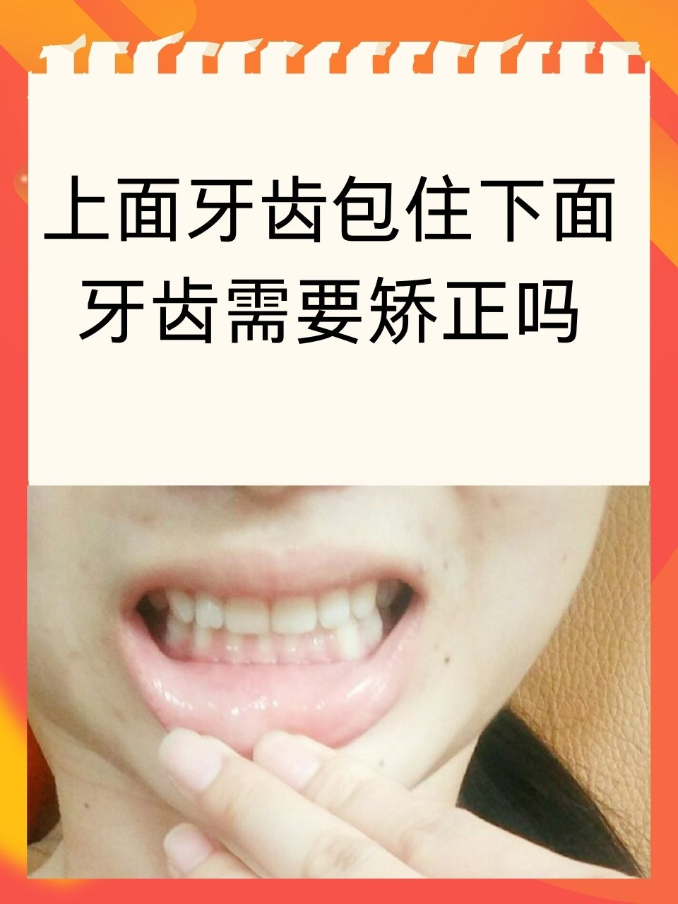 上面牙齿包住下面牙齿需要矫正吗