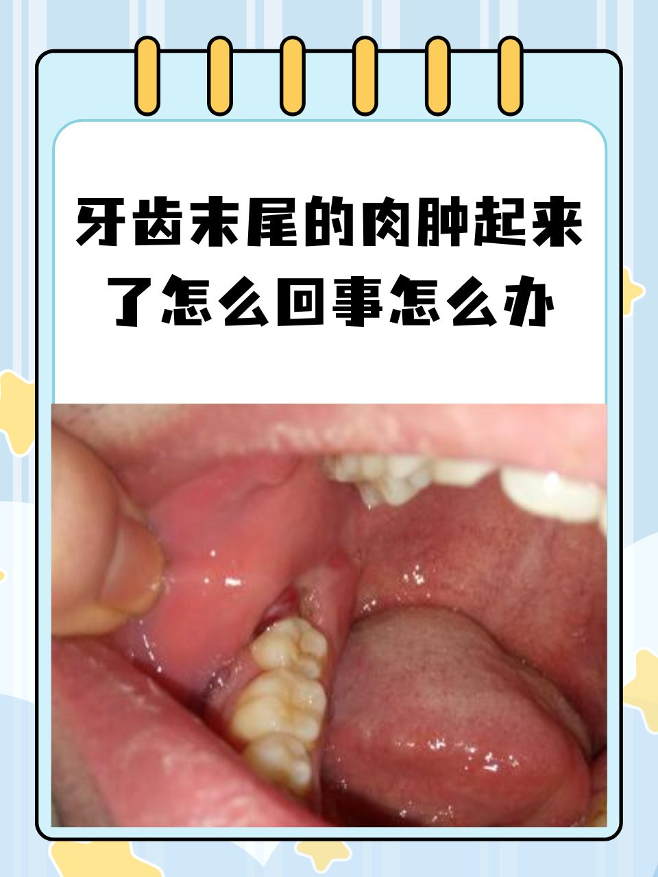 牙齿末尾的肉肿起来了怎么回事怎么办?