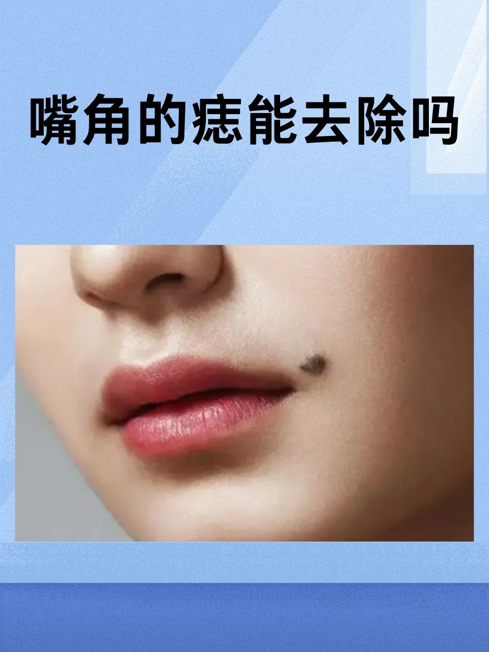 嘴角的痣能去除吗
