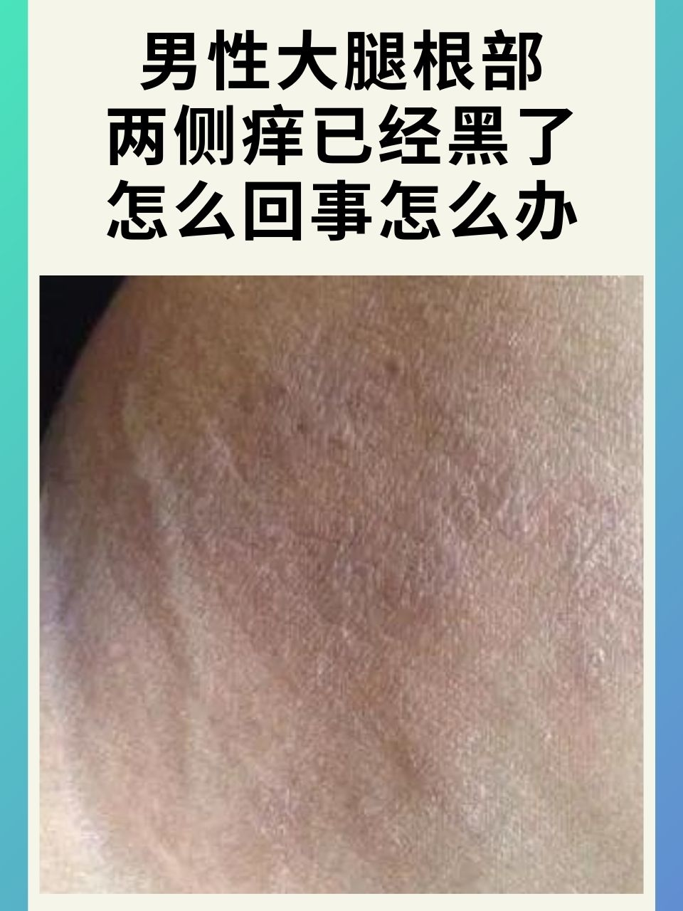 男性大腿根部两侧痒已经黑了怎么回事怎么办?