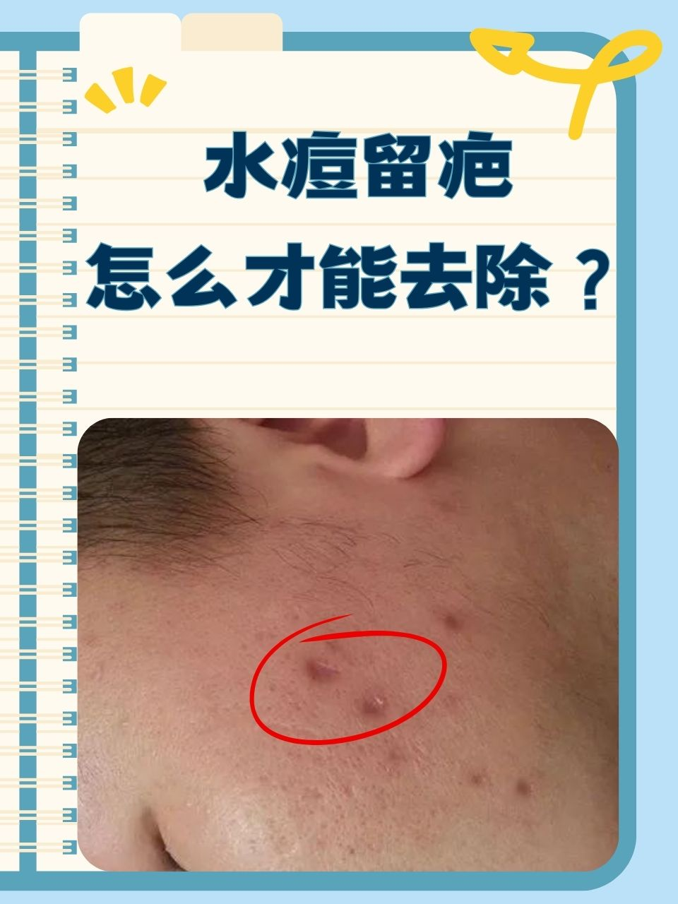 水痘留疤怎么才能去除?