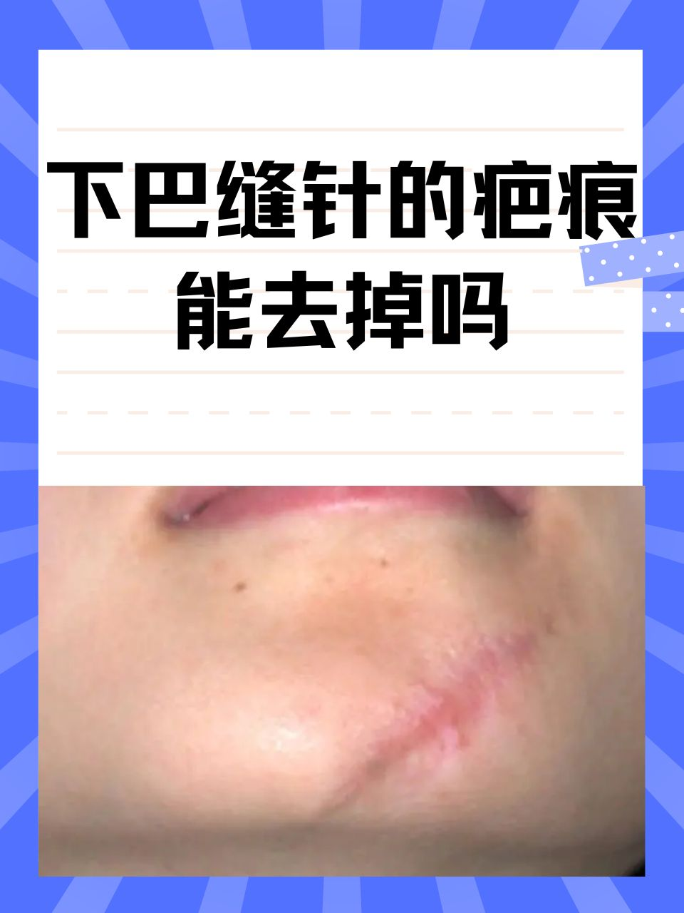 下巴缝针的疤痕能去掉吗