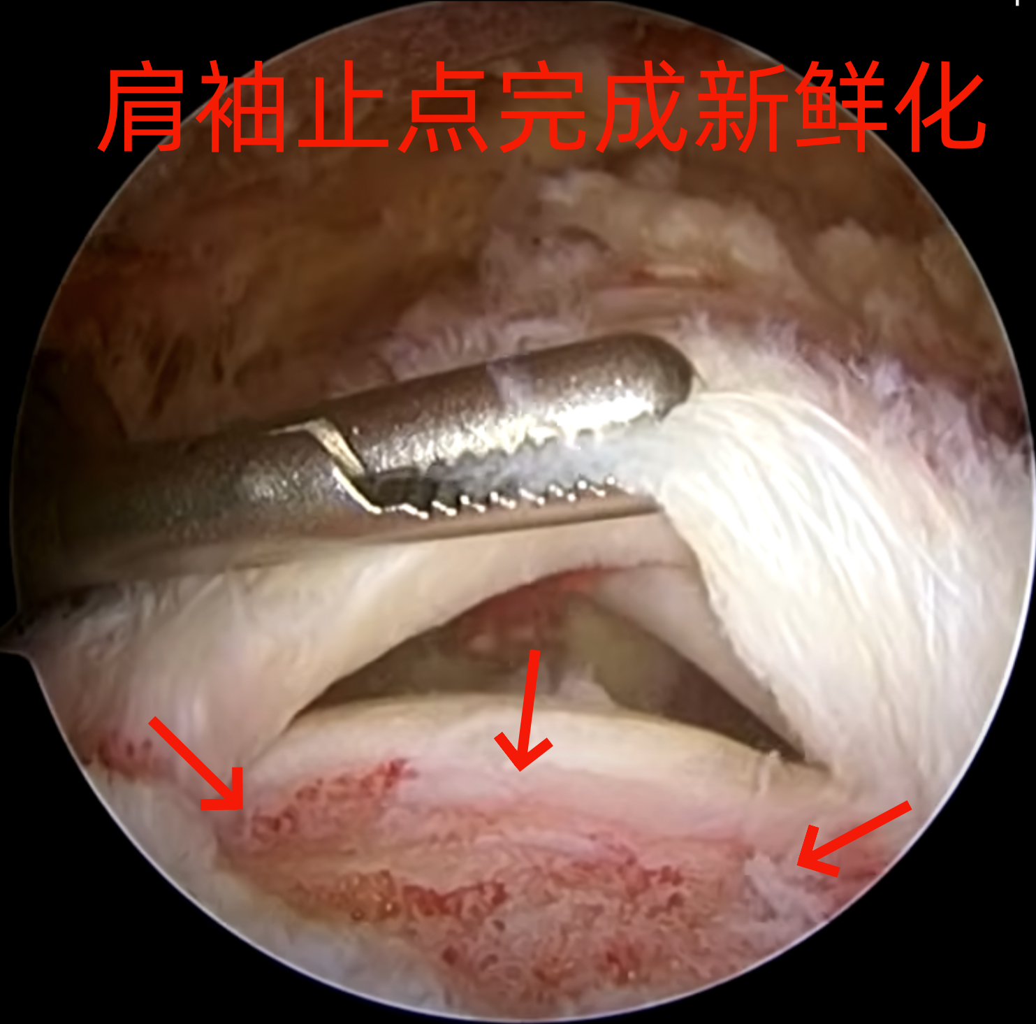 如何增加肩袖修复手术的愈合率!