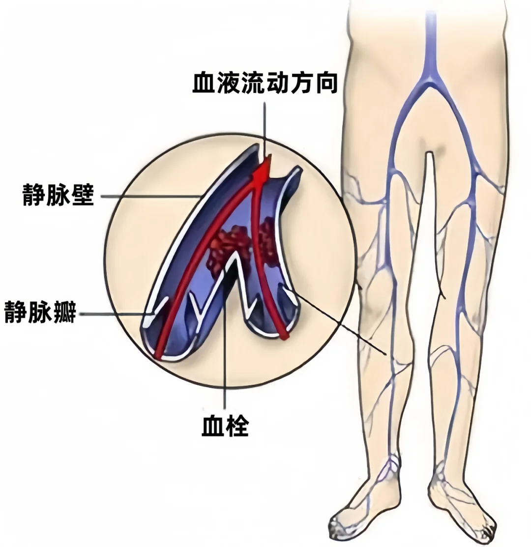 下肢深静脉血栓形成的治疗