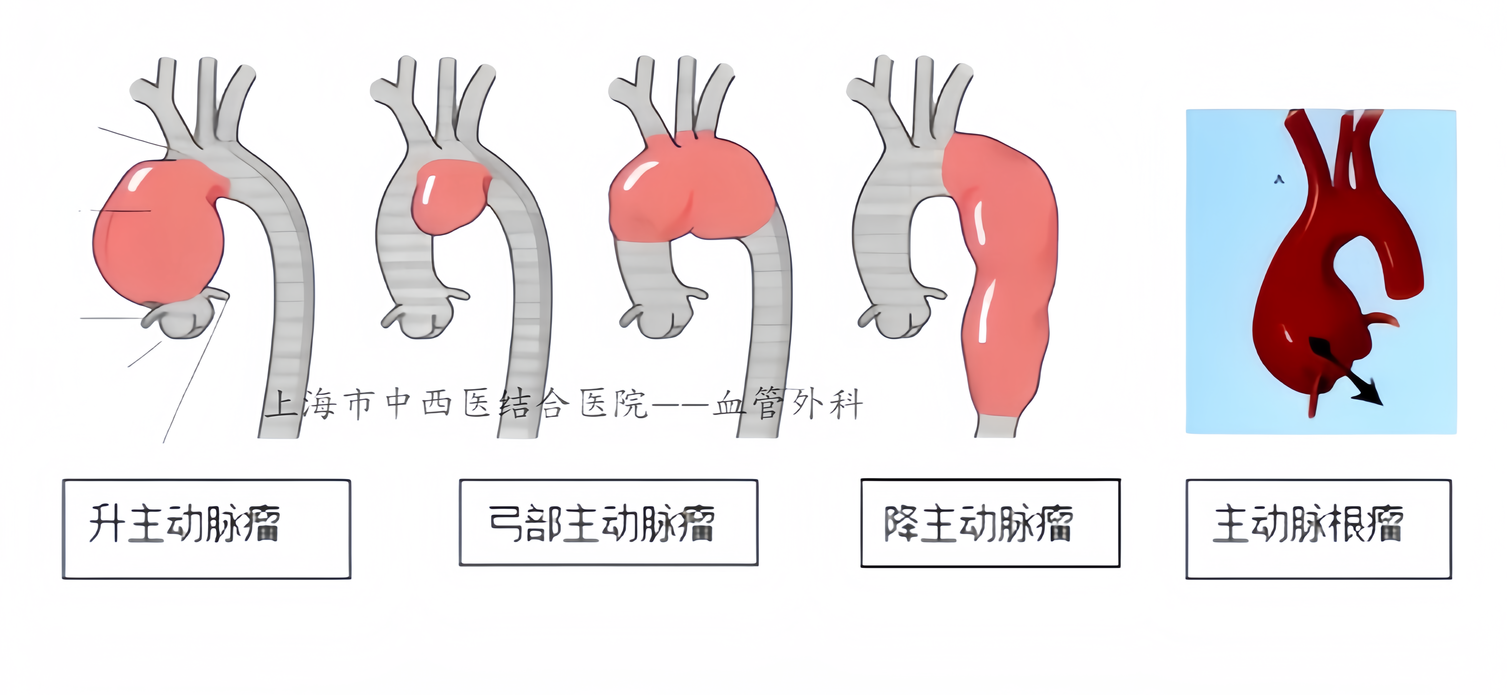 主动脉直径图片