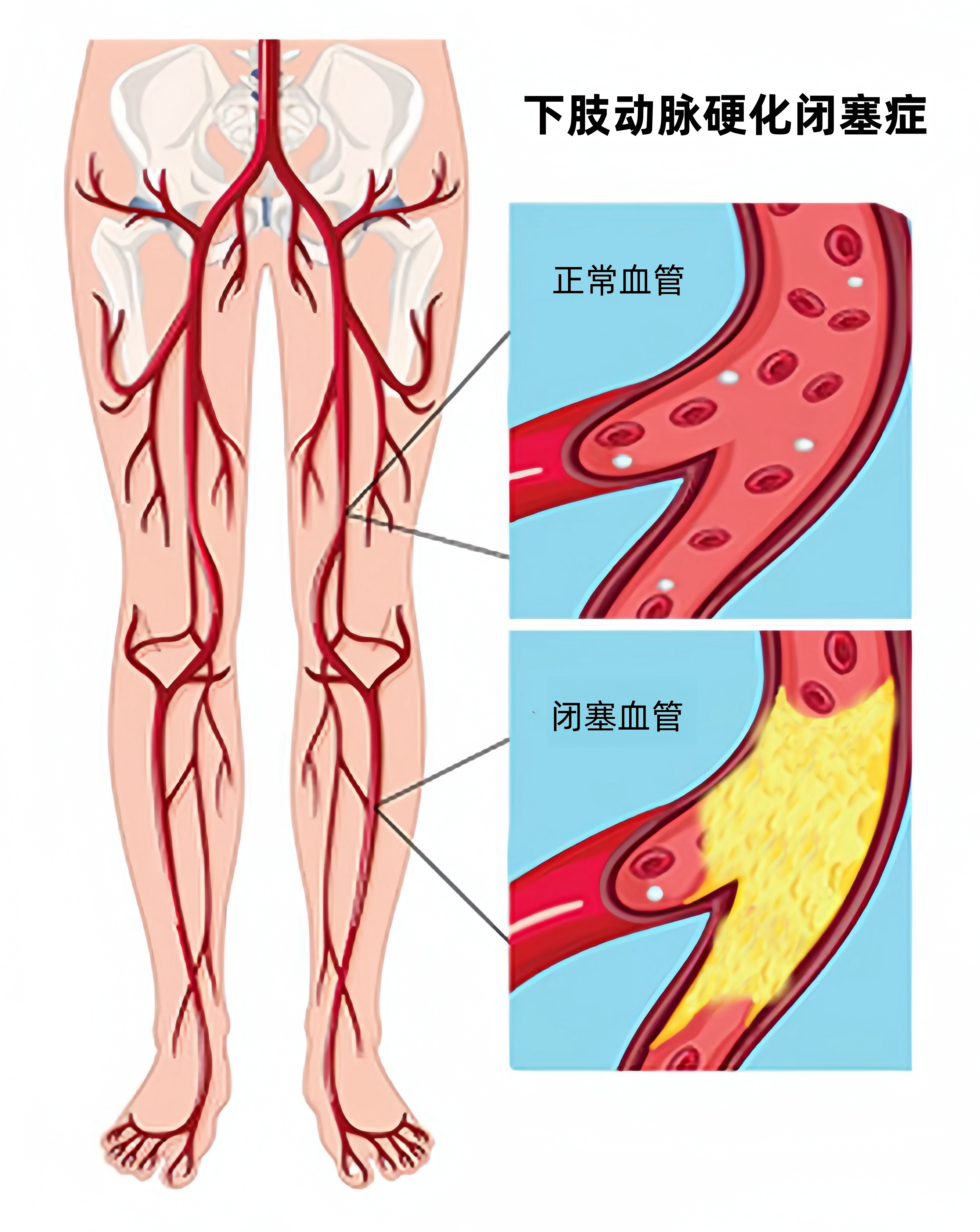 「健康科普」认识下肢动脉硬化闭塞症"