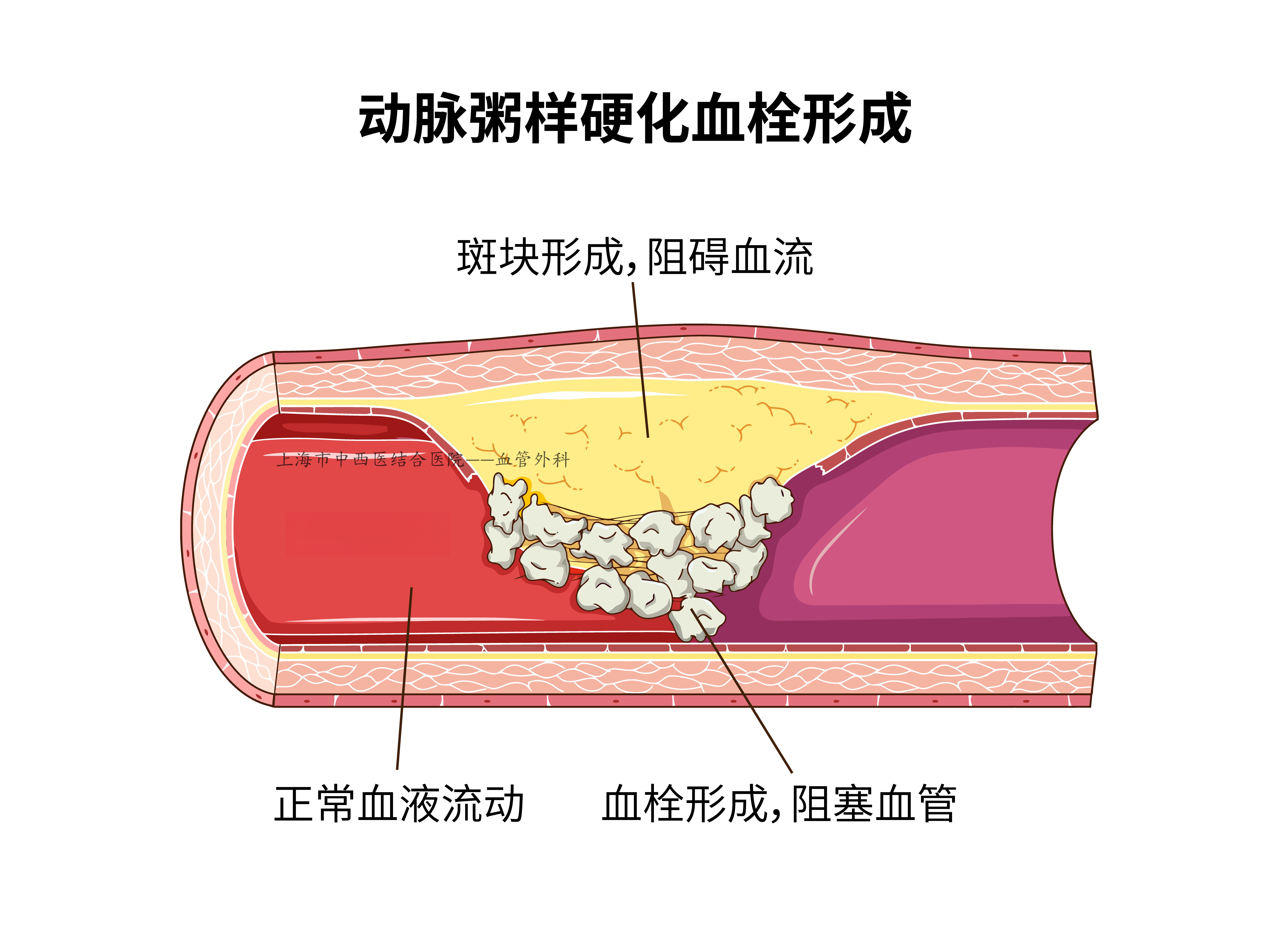 「健康科普」浅谈动脉硬化斑块