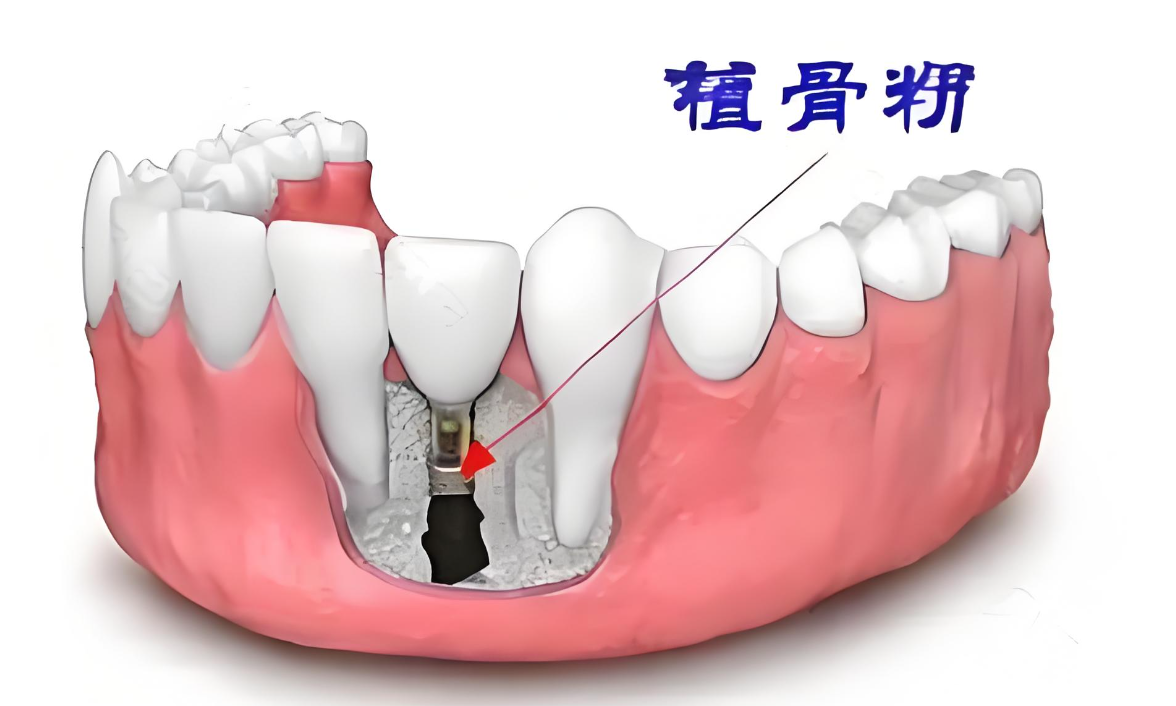 去种牙为什么医生让植骨?是在忽悠人吗?做种植牙植骨痛苦吗?