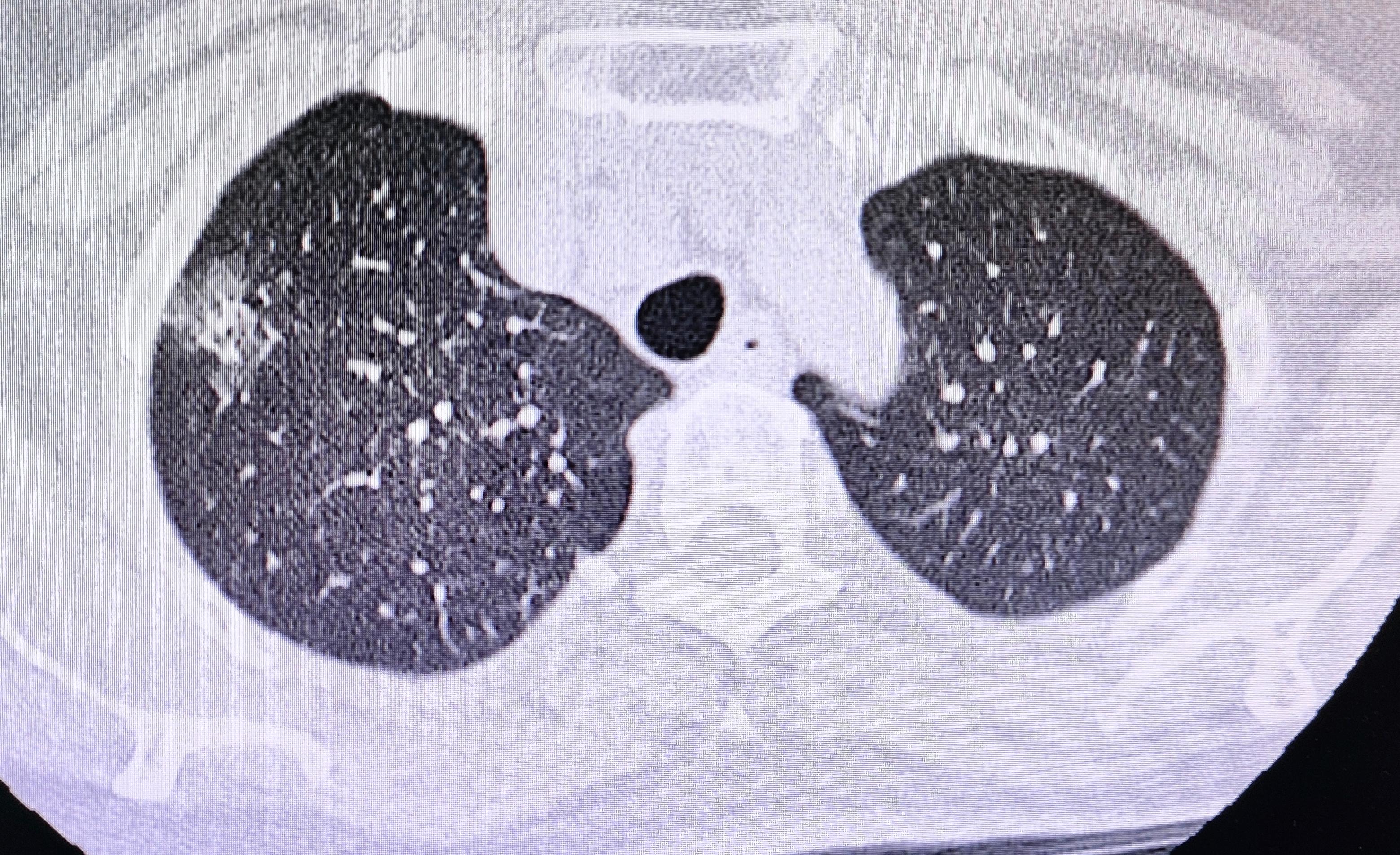 肺结节大小的分类