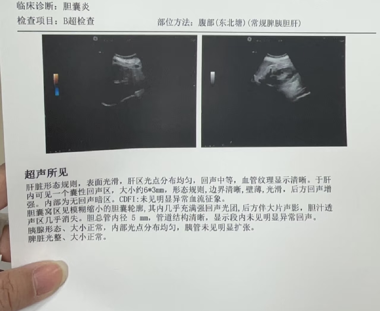 长期不吃早餐查出胆结石?32岁女性改变习惯,3个月后改善明显