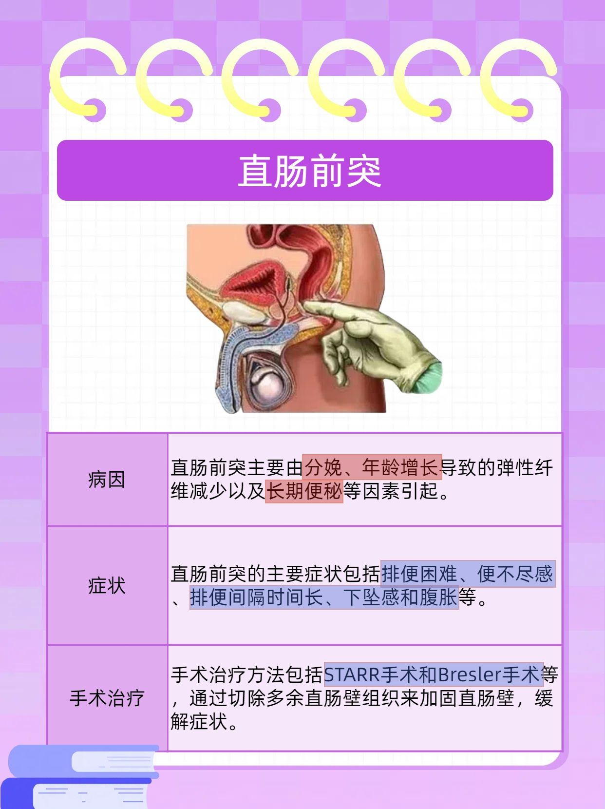 直肠前突最佳治疗方法图片