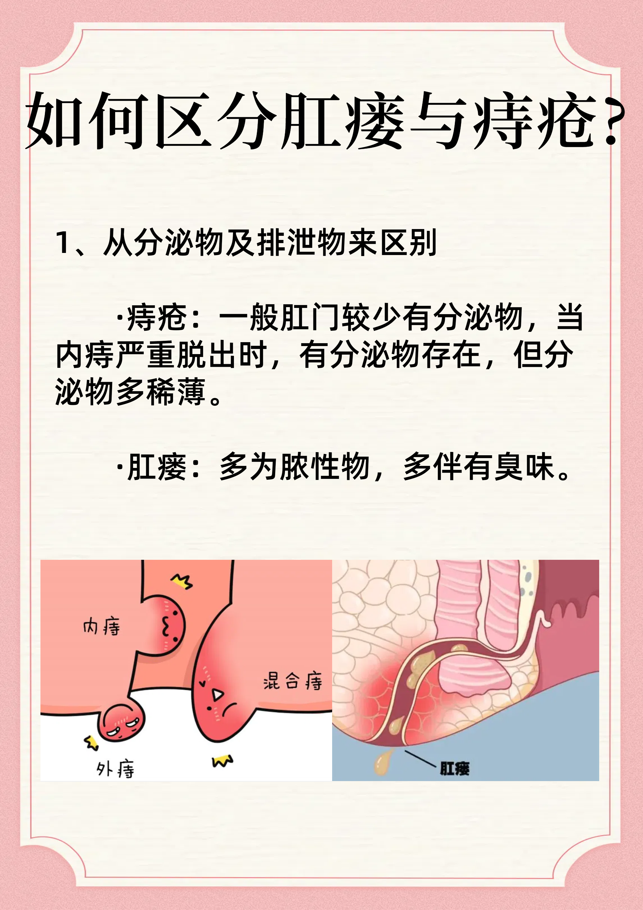 肛瘘和痔疮的区别图片