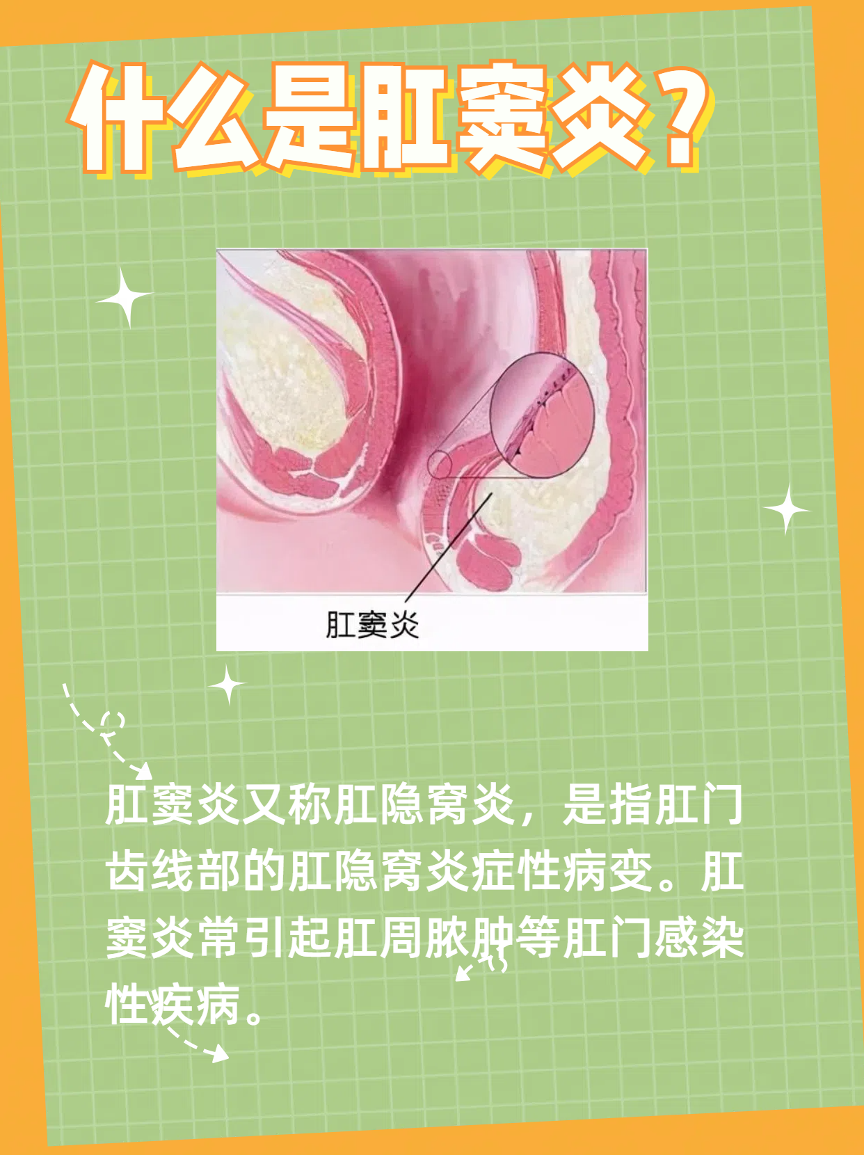 肛窦炎的症状揭秘