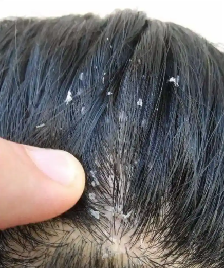 头皮屑多且大块还结痂,头皮屑很多如何去除?