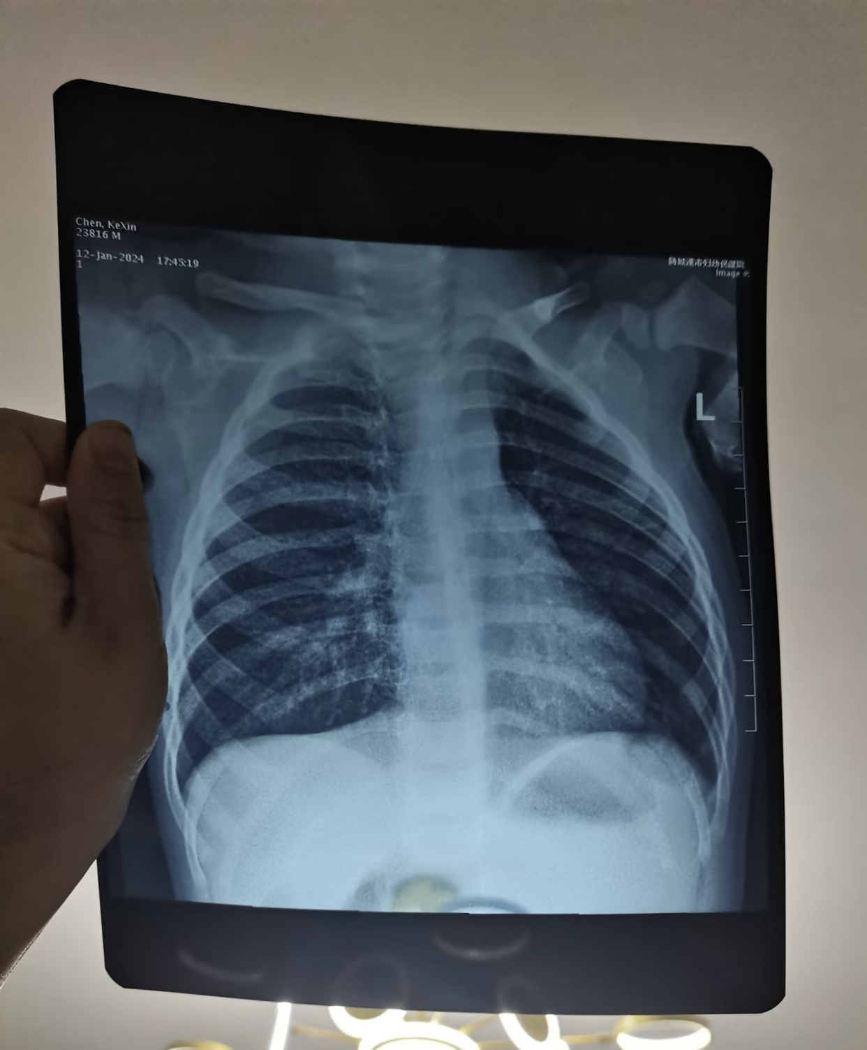 咳嗽超两周速查!儿童支气管炎易误诊,医生总结3个鉴别诊断要点