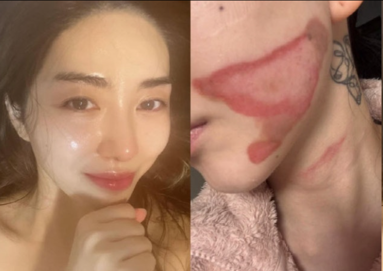 AOA前成员权珉娥公开毁容近照，面部深二度烫伤控诉医美事故！