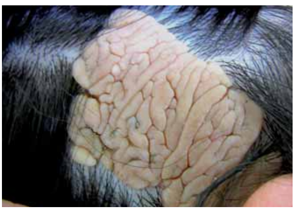 脑回状皮脂腺痣的简介