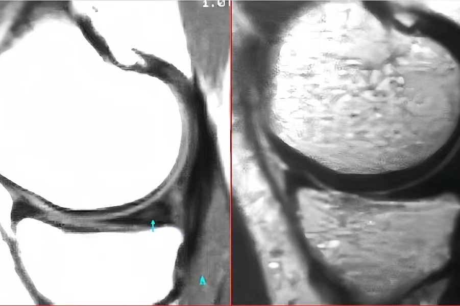 也称为轻度损伤,主要表现为半月板的轻度变性,可能伴随轻微的水肿或小