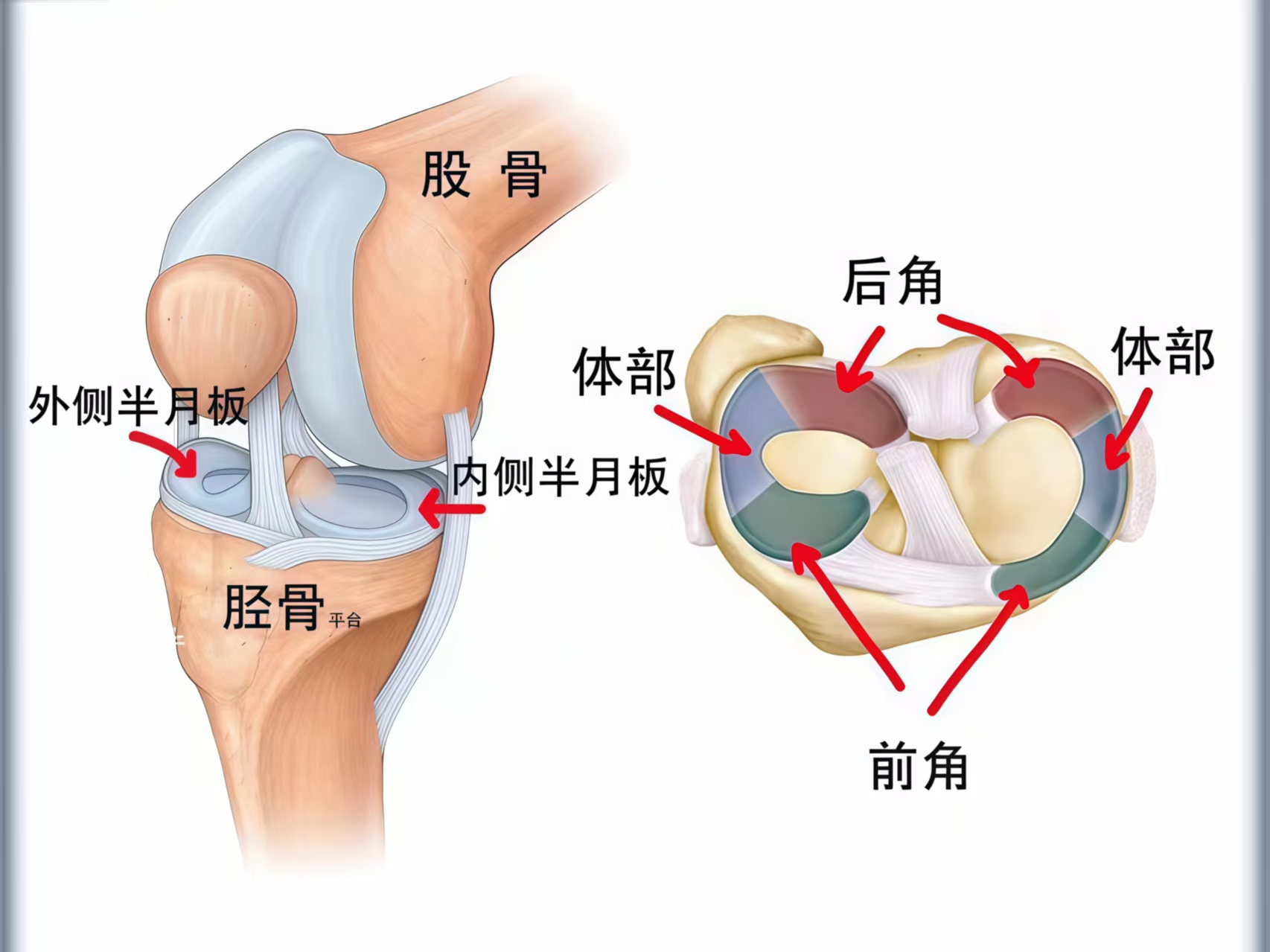 半月板分内侧半月板和外侧半月板,然后半月板一般分为前角,后角以及体
