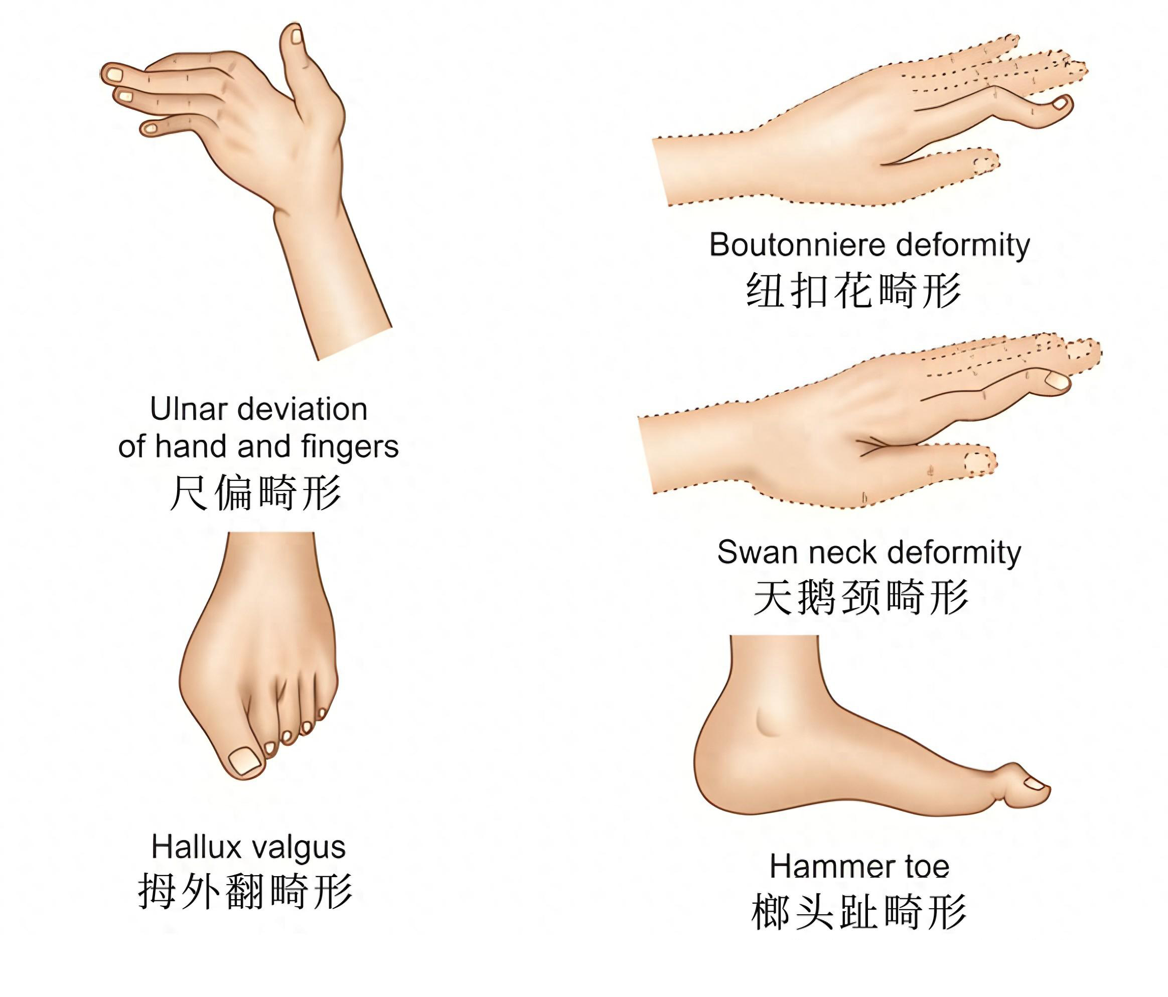 在风湿免疫科,我们经常能看到一些晚期类风湿患者,手指关节出现各种