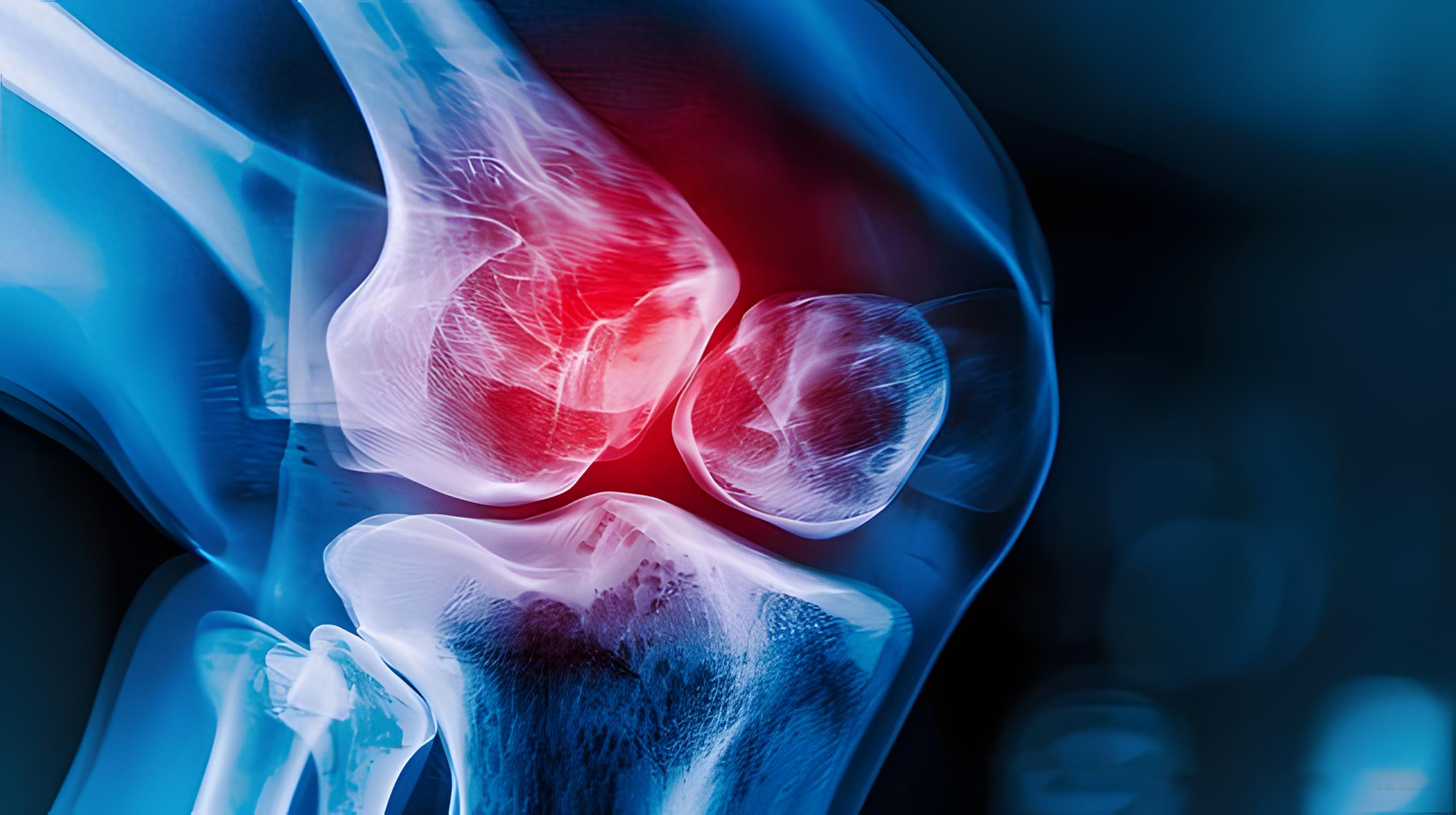 膝关节滑膜发炎增生危害大吗?关节积液的患者该怎么办?