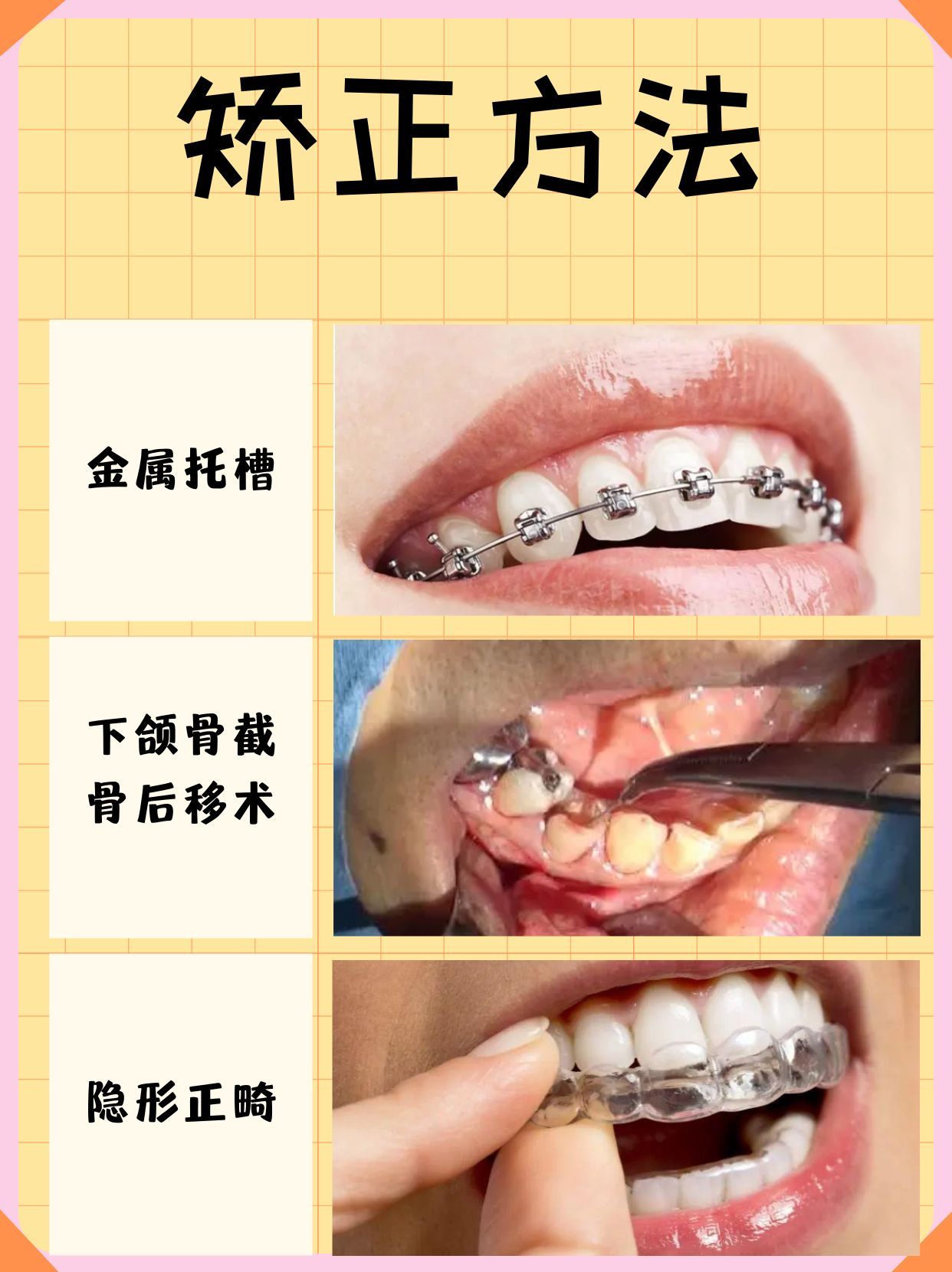 牙齿地包天矫正:小改变,大不同!解锁你的微笑密码