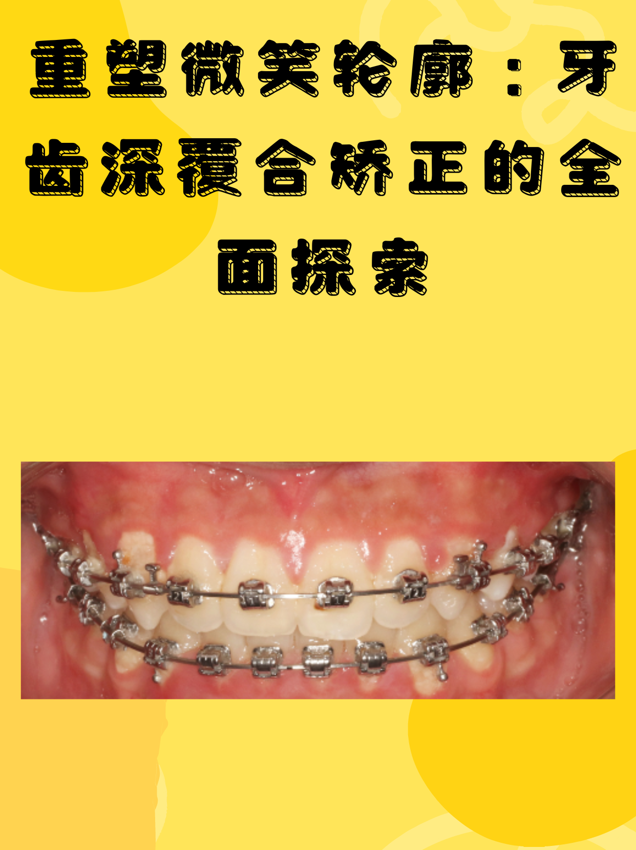 深覆合矫正挑战解析:难度,效果与美丽重生
