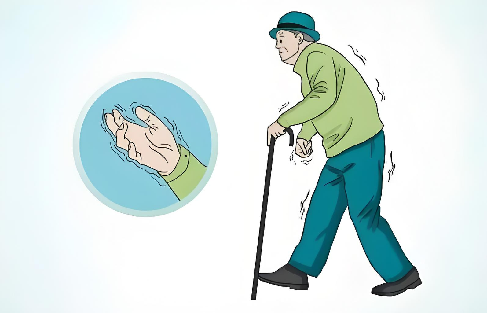 震颤:病因,病机,临床表现与中西医治疗
