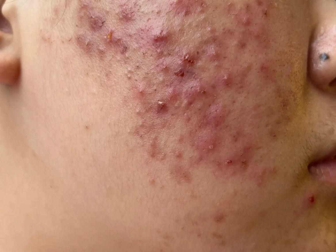 脓包型痤疮的成因与科学应对:告别痘痘困扰的实用指南