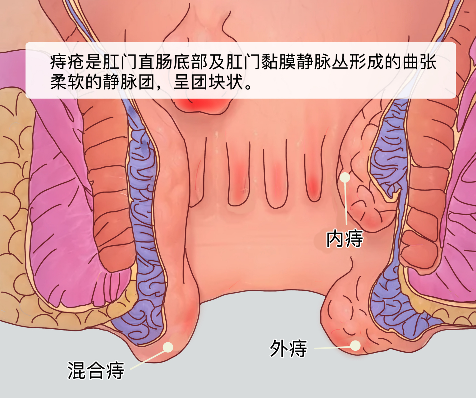 不同痔疮的图片 初期图片