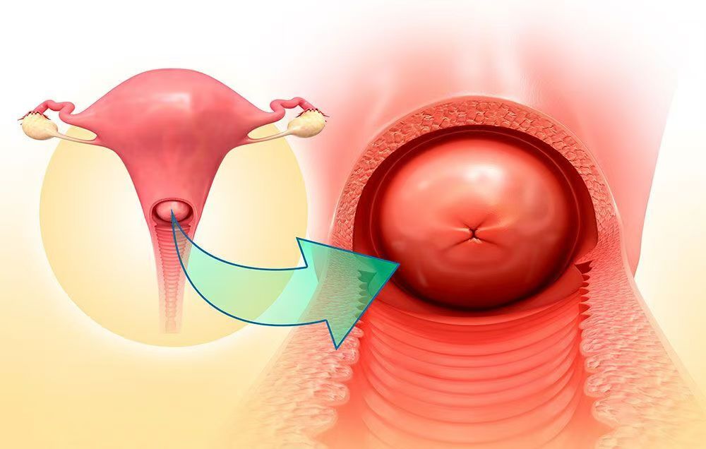 女人宫颈肥大图片图片
